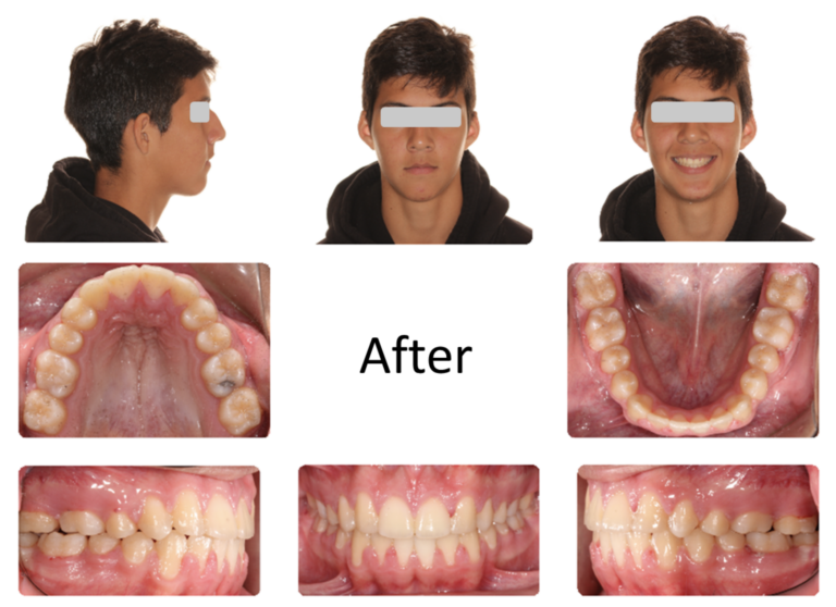 Post-treatment intra and extra-oral image. 