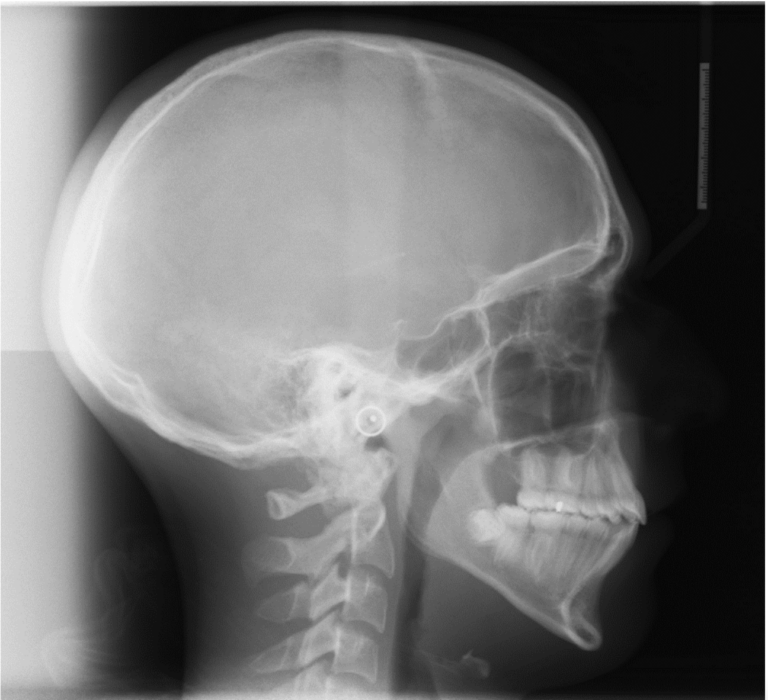 Post-treatment untraced cephalometric radiograph.