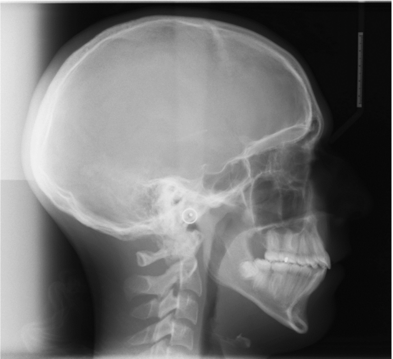  Post-treatment untraced cephalometric radiograph. 