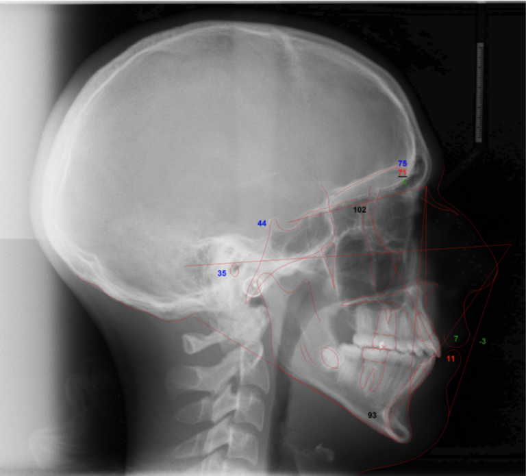 Post-treatment traced cephalometric radiograph.