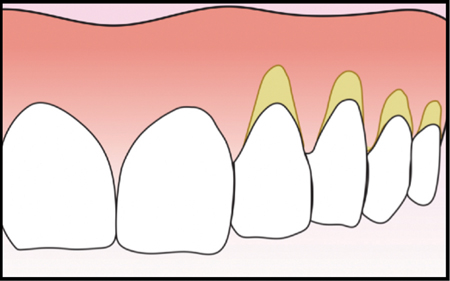 Multiple Gingival Recession Defects.  