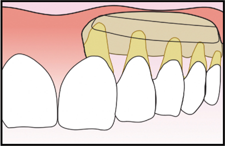 Collagen Base Layer Placed on Alveolar Bone. 