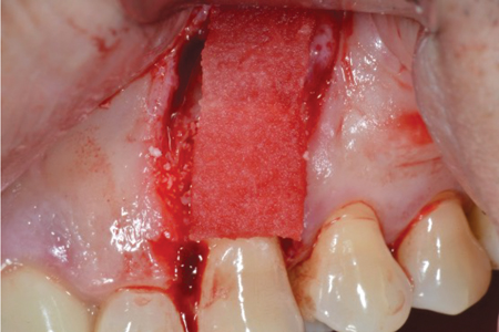 Placement of specialized collagen in an S2 Sta.