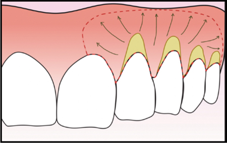 CRAFT circumferential, vertical, and oblique periosteal release.