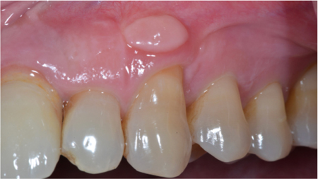 Post Surgical healing 3 years follow up. 