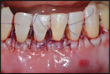 . Primary wound apposition utilizing the coronal rotational advanced flap technique and stabilized with a combination of D2 and S-loop suturing technique. 