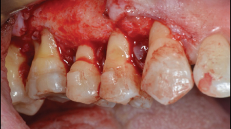 . Surgical flap elevation and release. 