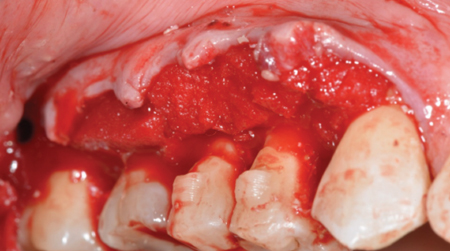  Placement of apical base layer of collagen.