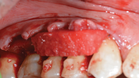 Placement of coronal secondary collagen layer.