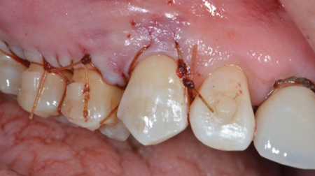 CRAFT Surgical Closure with corresponding S-loops/
D2 Slings.