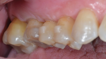 Post operative healing and
stabilization at 3 months