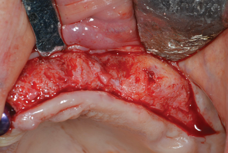 Surgical maxillary left surgical entry. 