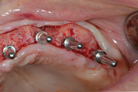  Initial implant osteotomy sites with paralleling indices.  