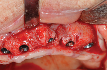 . Oral Implant placement with Megagen Blue Diamond fixtures for the upper left maxillary arch. 