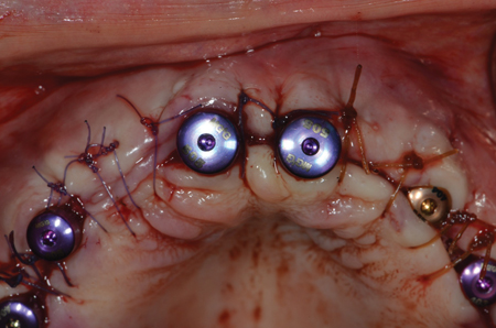 . CRAFT Release and Phenotypic Modification with surgical closure with primary wound apposition.