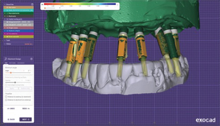  Exocad analysis and provisional abutment /crown design. 