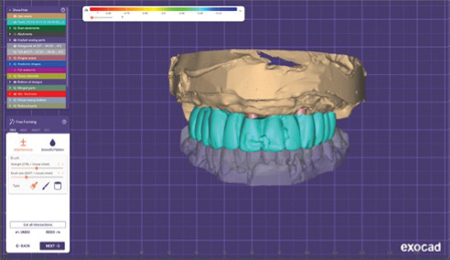 Exocad abutment and provisional crown design.