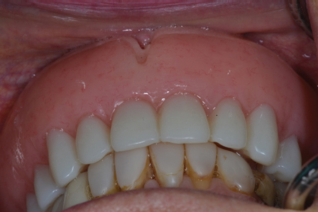 Maxillary Immediate Denture in situ.