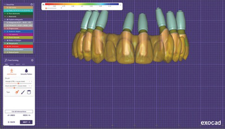 Exocad Final Prosthesis design and implant positioning. 