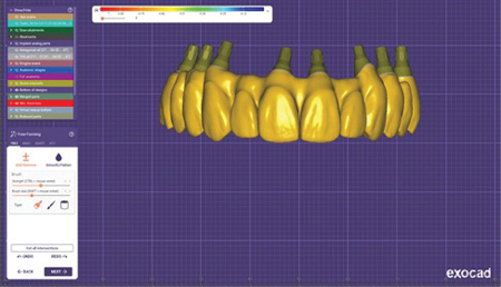 Exocad abutment and prosthesis design.  