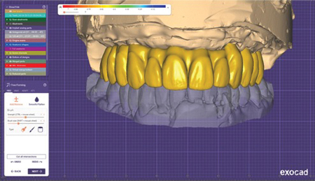 Exocad Zirconia block prosthesis design.