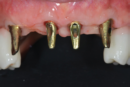 Direct to Implant custom anodized abutment for the anterior segment.  