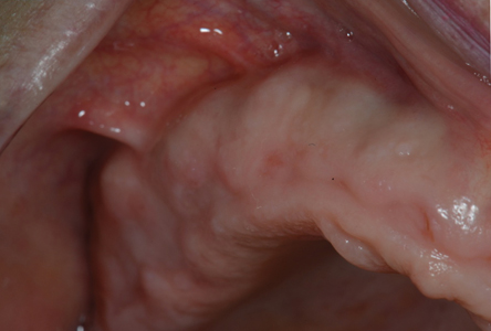  Presurgical view of right maxillary surgical site. 