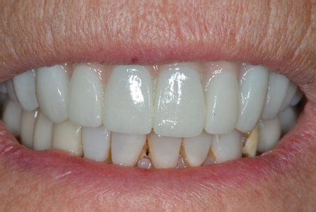 Overall Patient Smile and Aesthetic Outcome.