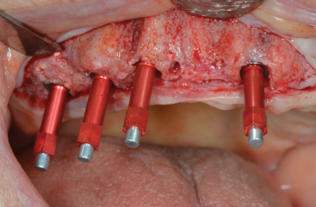 Measurement of ISQ with Osstell smartpegs.