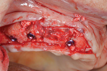 Amnion Chorion Placental (Bioxclude) Membrane placed over the hard tissue graft.