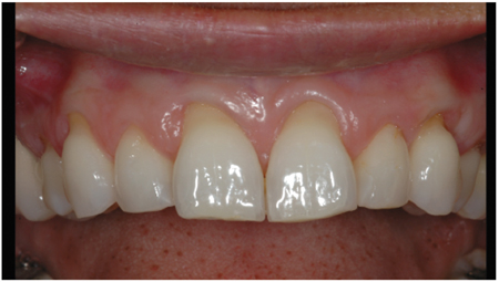 Presurgical View Class II-III Anterior Recession.  