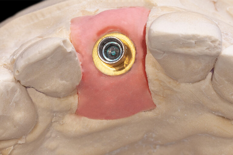 Image of the working model where we can see the positioning of the interface at the juxta-gingival level. 