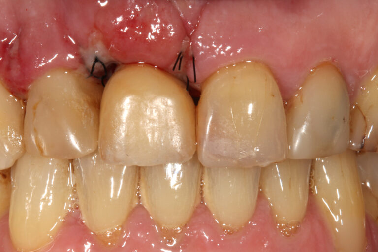 Provisional crown in place 24 h after implant insertion. This will form the emergence profile and guide the healing of the soft tissue. 