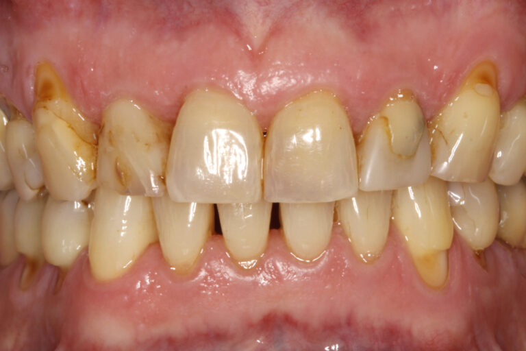 . Clinical image of the patient where the problem of tooth 11 is not visible. 