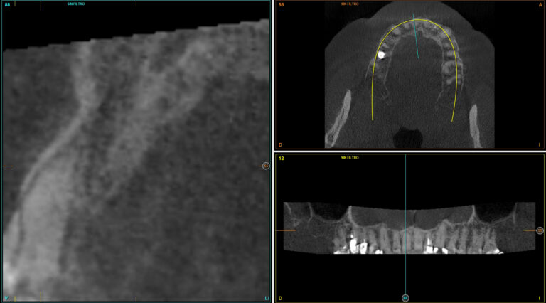 Sectional section of the diagnostic cone-beam where we can observe the fracture of a vestibular corono-radicular portion of the tooth 11 and clinically.  
