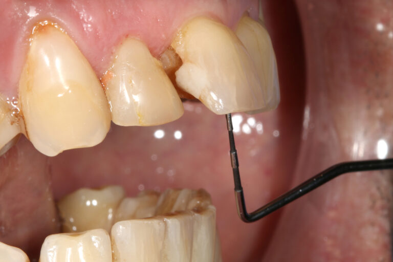 Sectional section of the diagnostic cone-beam where we can observe the fracture of a vestibular corono-radicular portion of the tooth 11 and clinically.  
