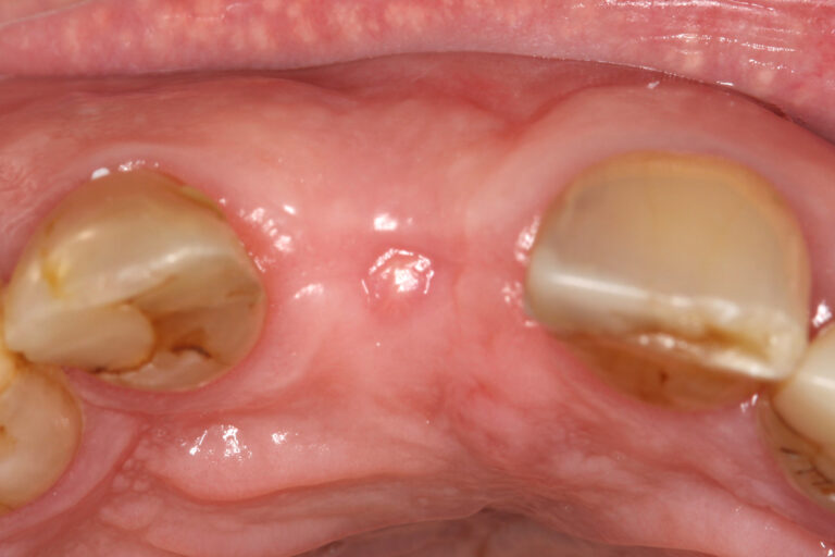 Clinical images after exodontia and alveolar regeneration with PRGF-Endoret.