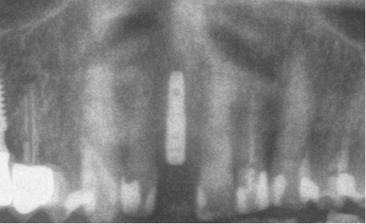 Radiographic image after insertion of the implant in position 11 and the transepithelial component for immediate loading. 