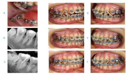  One mini-screw was inserted mid-buccal to the mandibular right second molar (A). A change in horizontal X-ray beam angulation (B and C). The mandibular bite plate was removed after three months of vertical traction (D). Vertical traction continued for two months (E) and two more months (F). 