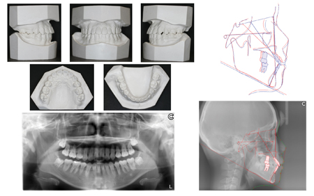 Posttreatment dental casts, lateral cephalometric and panoramic radiographs, and superimposition of pretreatment (red) and posttreatment (blue) cephalometric tracings on the anterior cranial base.  