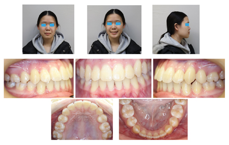 Facial and intraoral photographs at the 6-month follow-up.