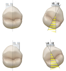  LightForce brackets do not need to be placed in the center of the tooth to achieve a straightwire finish.