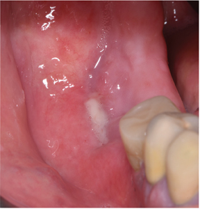 The draining fistula in quadrant four.