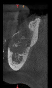 Cross section of the 46 area demonstrating bone loss.