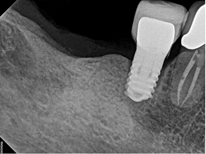 Peri-implantitis at 45. The extent of the destruction of the bone in quadrant four is noted in Figure. 3.