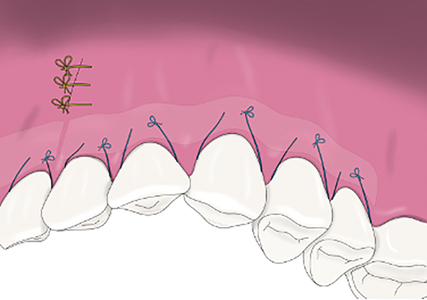  Suturing ensured tension-free closure of the repositioned tunnelled soft tissues over the allograft material. 