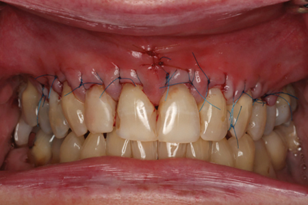 The immediate post-operative condition of the surgical site. 