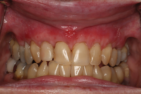 The sutures were removed after three weeks without complications. 