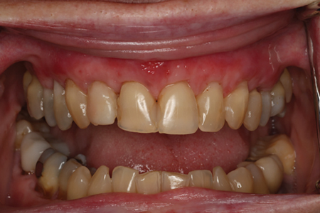 At two months post-op, healing appeared highly successful, with no signs of graft exposure. 