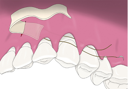  4-0 chromic gut suture needle was inserted into the tunnel distal to one first bicuspid and advanced mesially to emerge through the midline incision. One-half of the allograft was then engaged with the needle and dragged distally through the tunnel to cover the prepared surgical bed. 